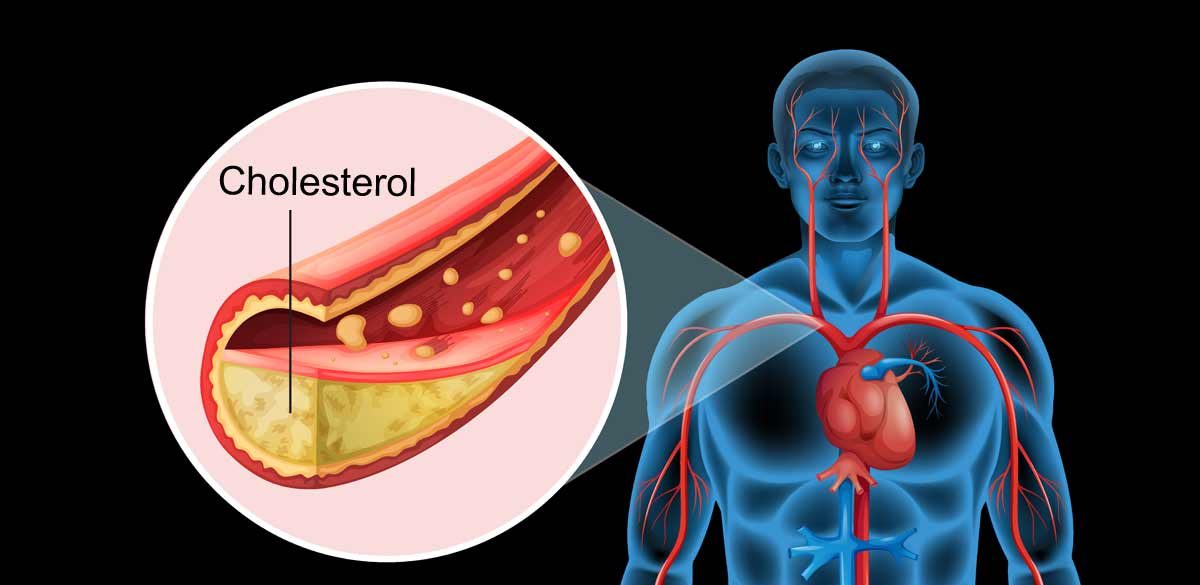 اسباب ارتفاع الكولسترول